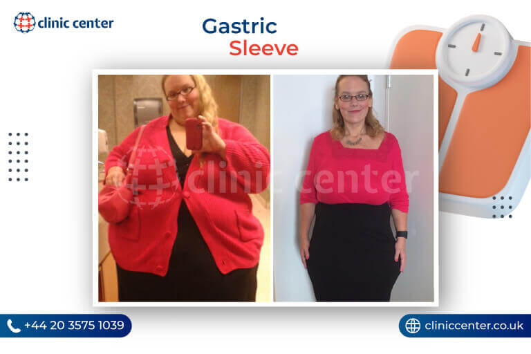 Gastric Sleeve in Turkey Before After
