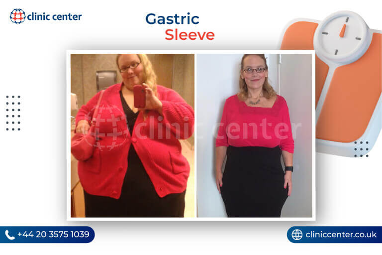 Gastric Sleeve Surgery in Turkey