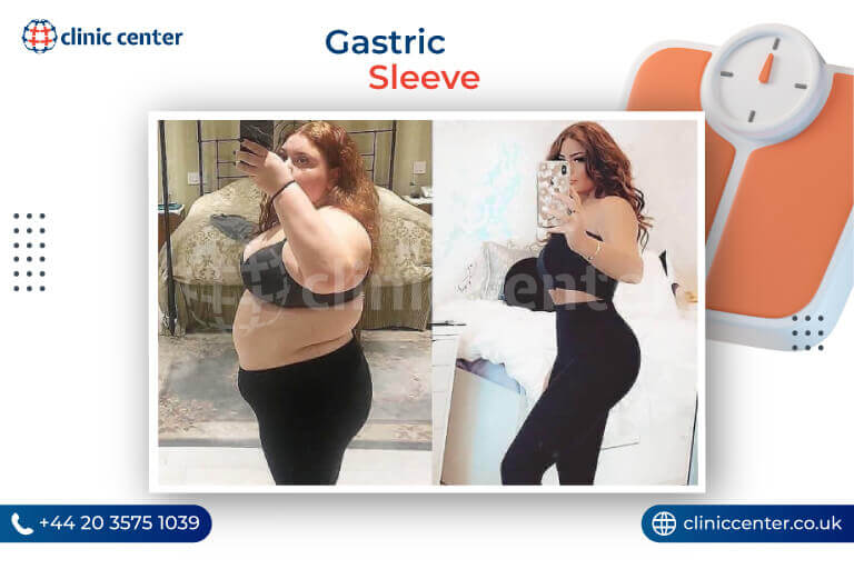 Gastric Sleeve in Turkey Before After