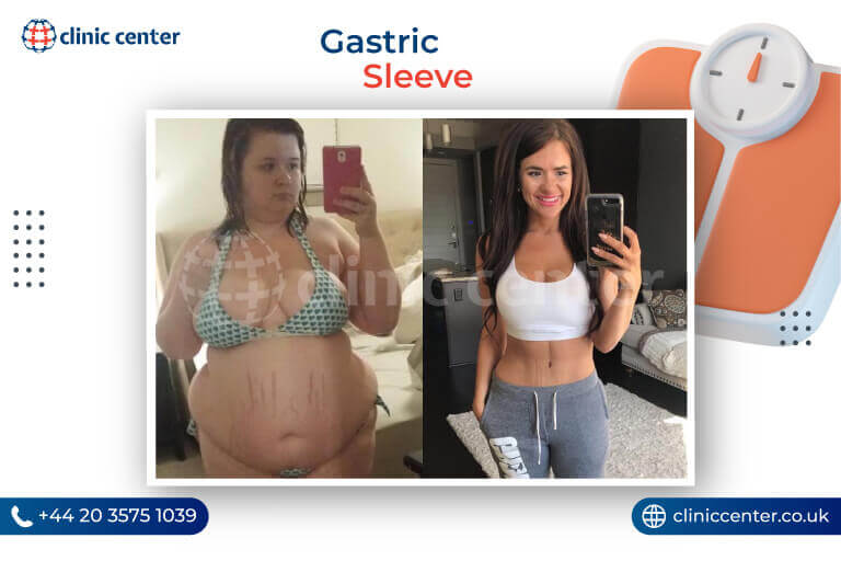 Gastric Sleeve in Turkey Before After