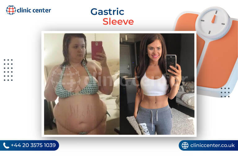 Gastric Sleeve Surgery in Turkey