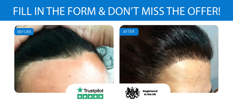 FUE Hair Transplant Liverpool | Top surgeons from £99/pm