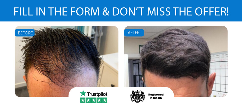 How Much Does a Hair Transplant Cost in the UK? - Prices in 2023