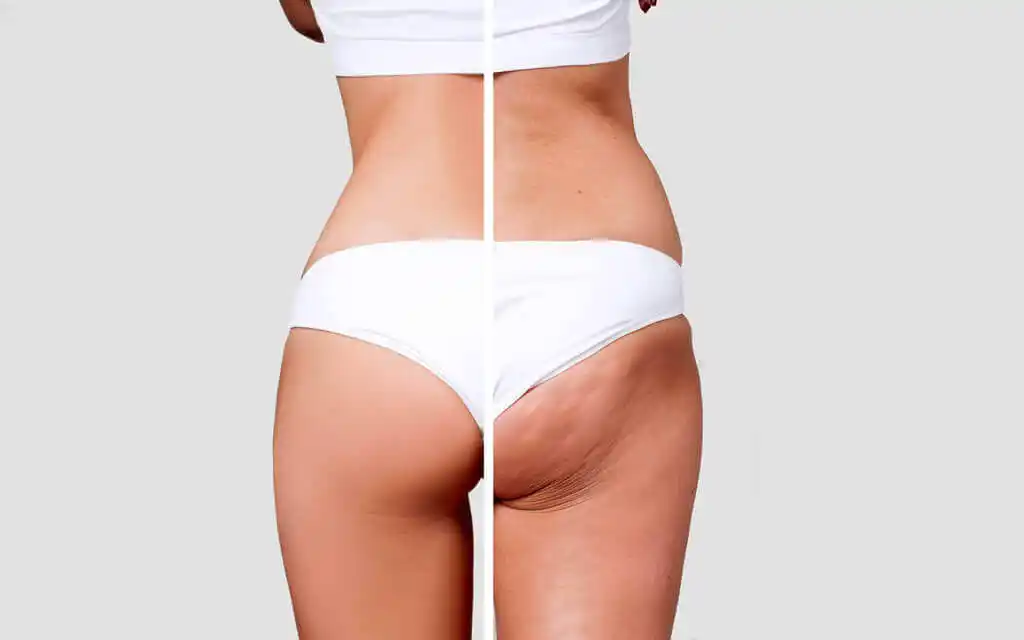 Body with Liposuction Turkey