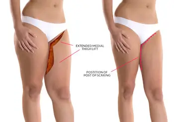 Thigh Lift – Spyrou Clinic