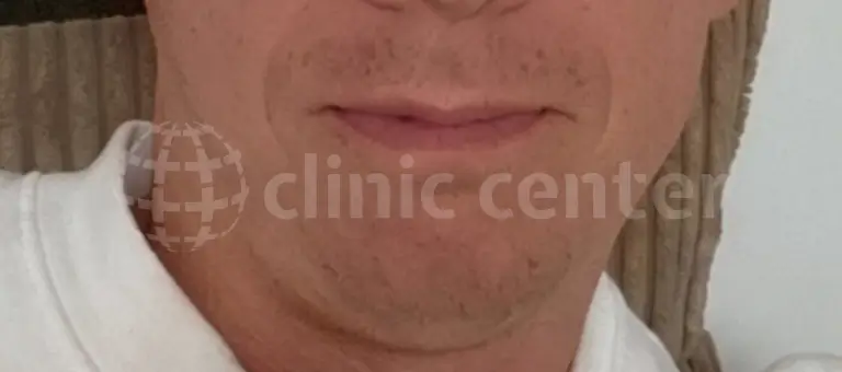Antes
