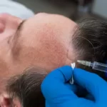 Hair Transplant in Turkey
