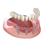 All-on-4 Dental Implants