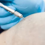 DHI Hair Transplant