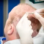 FUE Hair Transplant