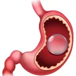 Gastric Ballon