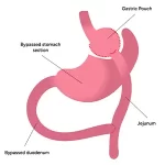 Gastric Bypass
