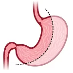 Gastric Sleeve