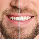 Gingivoplasty & Gum Surgery
